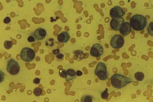 Photo credit: Cercetători din SUA au folosit virusul pojarului să 'curețe' mielomul